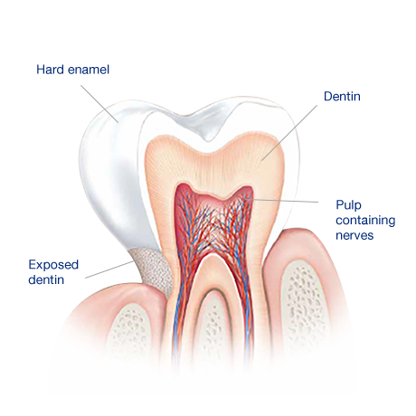 What Causes Sensitive Teeth? What Causes Sensitive Teeth?
